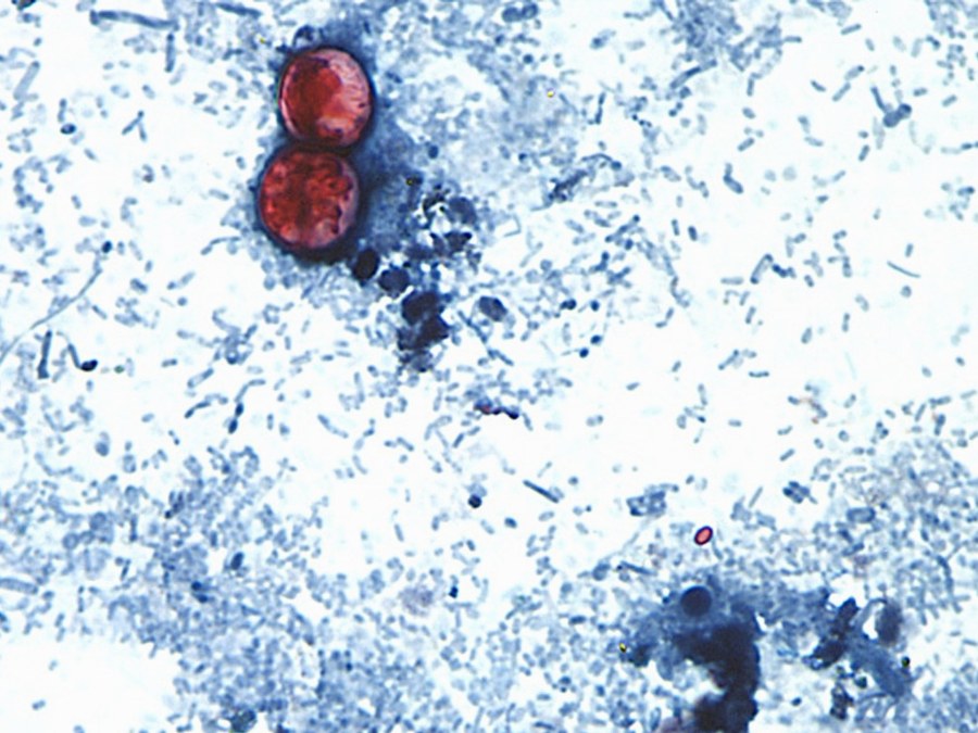 Michigan Confirms First Cyclospora-Linked Fatalities in US